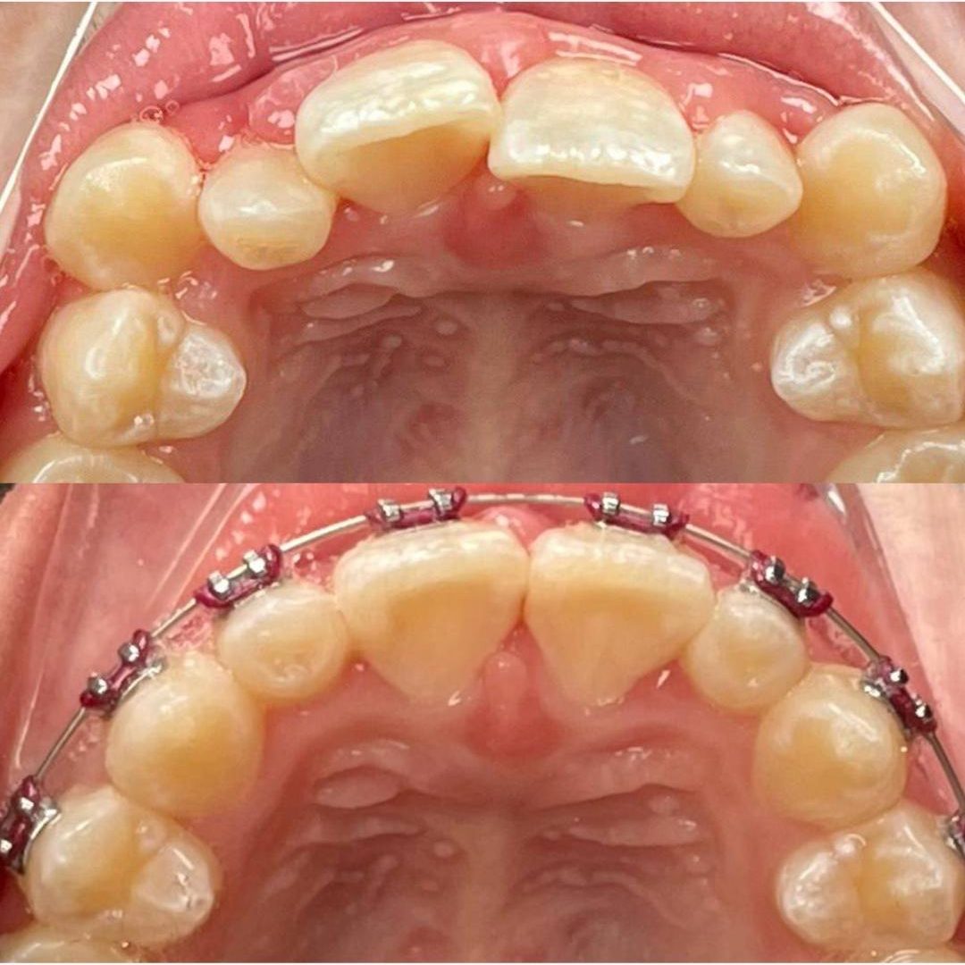 Before After IG Feed